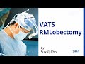 Rmlobectomy vatsassisted thoracoscopic surgery