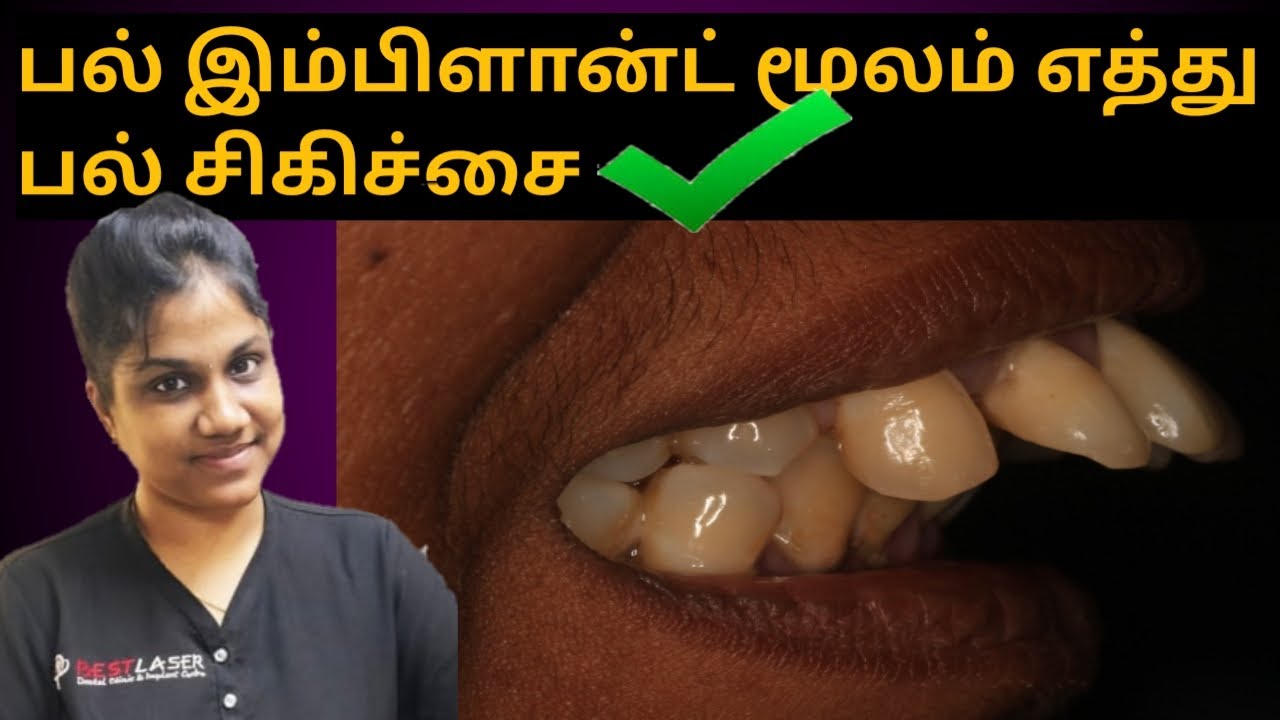 கிளிப் இல்லாமல் முன் பற்கள் சிகிச்சை/ எத்து பல் சிகிச்சை / Dental