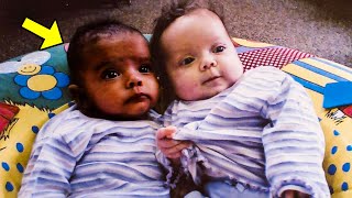 These Twins Were Born With Different Skin Colors. You Won't Believe What Later Happened To Them