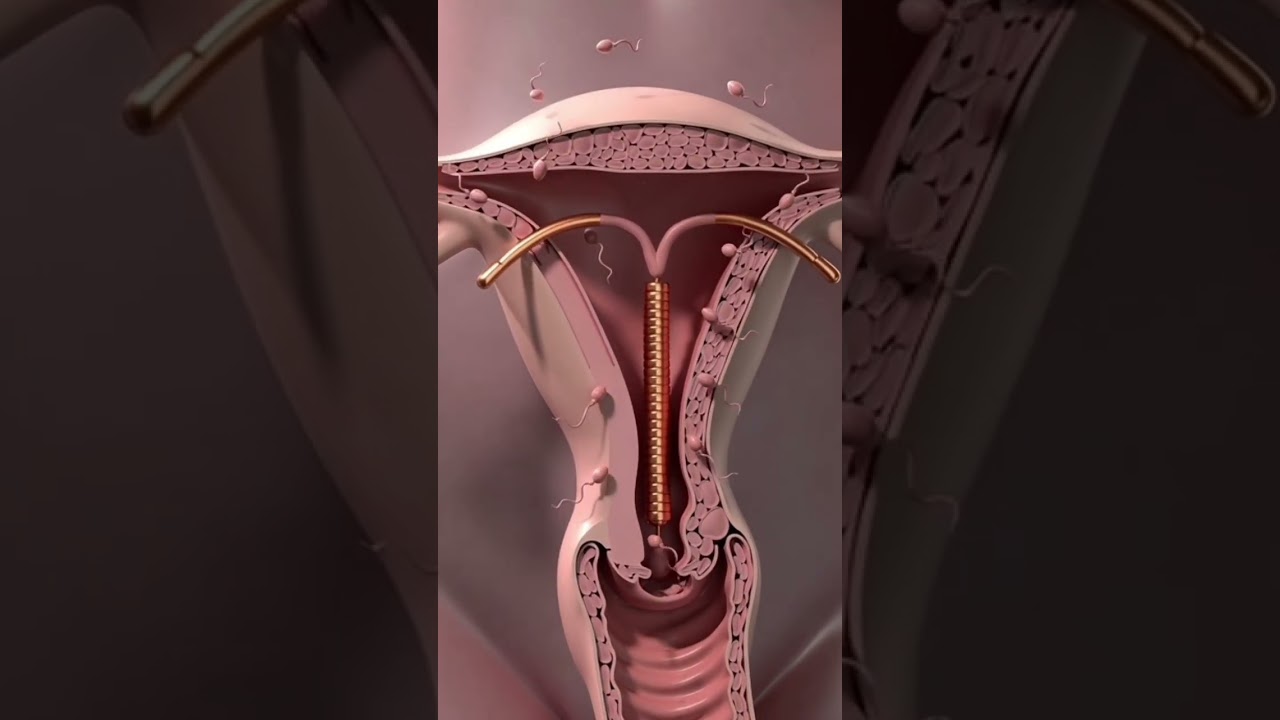 How Cooper IUD Works Inside Body 