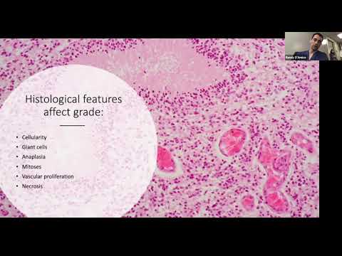 Virtual Neuro-Onc: Low grade gliomas with Dr. Randy D&rsquo;Amico