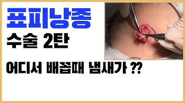 피부혹 수술영상 [표피낭종 수술 2탄, 덤덤TV]