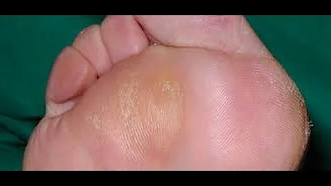 Come curare i duroni ai piedi?