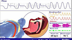 Understanding Sleep Disordered Breathing