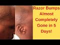 Razor Bumps Gone in 5 Days!