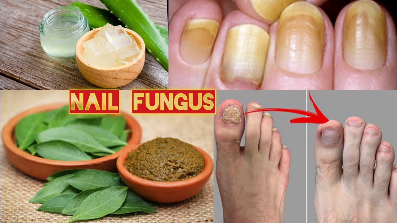 Effective Foot Soak for Toenail Fungus: Quick Home Remedies That Work |  Modern Foot & Ankle