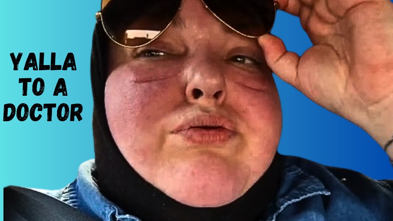 Foodie Beauty's Startling Face Edema (Swelling)