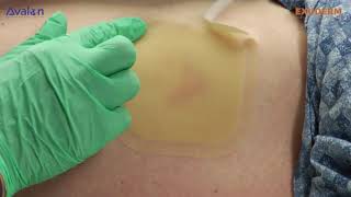 Exuderm, guía de aplicación
