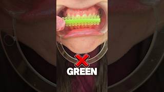 What braces color should you avoid ? ❌️