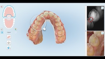 Dr  Rafi Romano - iTero 5D NIRI