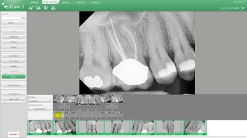 Vatech [EzDent-i] - ACQUISITION Onglet 05 : Importer des images FMX