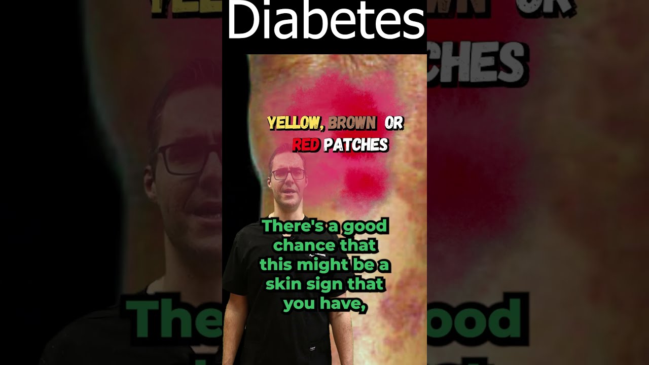 Necrobiosis Lipoidica Diabeticorum Diabetes Symptoms Sign 