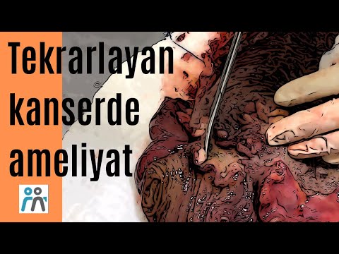 5 Yıl sonra tekrar eden kalın bağırsak kanseri tekrar ameliyatla tedavi edildi