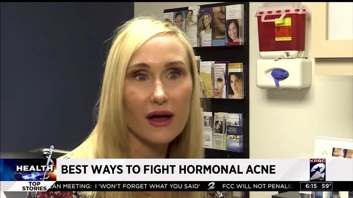 How to Treat Hormonal Acne