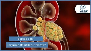 Böbrek Taşı Düşürme Belirtileri Nelerdir? Böbrek Taşı Böbrek Taşı Tanısı