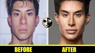 Justin Jedlica - 👧 Ken Doll Plastic Surgery Before and After 👧 - ( Muscle Implants )