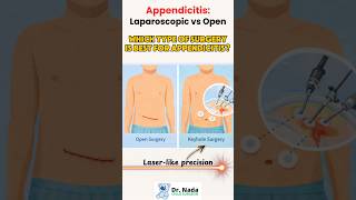 Appendicitis Surgery: Keyhole vs Open – Which is Better? #appendicitis #childhealth #pediatrics