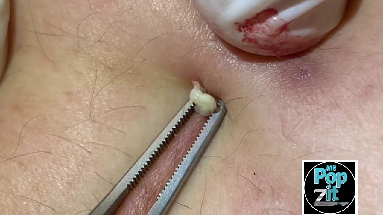 10 minutes of close up extractions. Blackheads, whiteheads, follicular cysts, ingrown hairs. pops