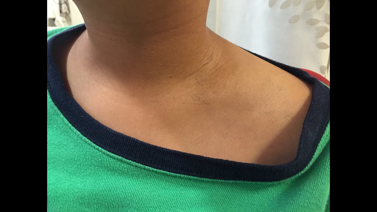 Fall Onto R Shoulder Fall onto Left Shoulder with Pain in 9 y.o. Boy - YouTube