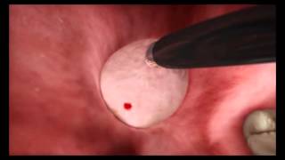 Adenoidectomy using PROCISE XP Wand.