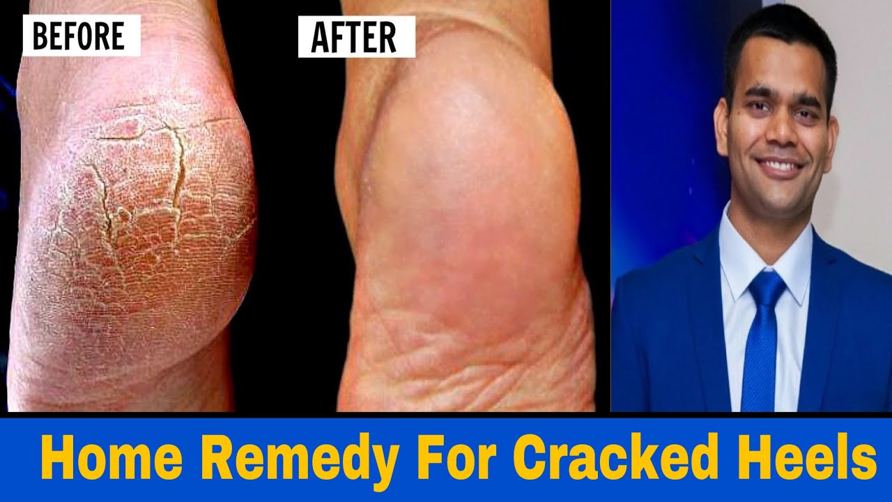 Discover the best cure for dry, cracked heels | Bare Feet