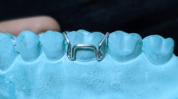 Adams Clasp | Orthodontics | Dental Occlusion