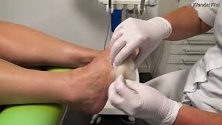 Wandelwol - Kleermakersknobbel