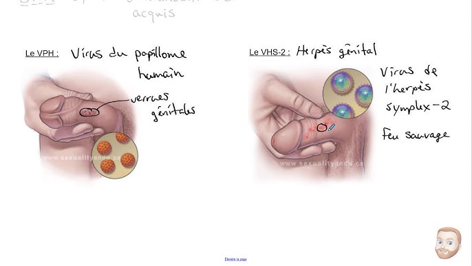 Les petits boutons sur le pénis (couronne perlée, grains de ...