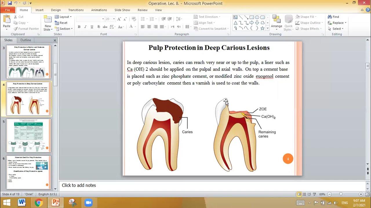 Operative Dentistry. Lec 8. Dental Cements; liner materials. YouTube