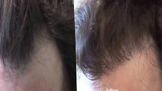 800 FUE Graft Hair Transplant Result by Dr Ray Woods in Sydney