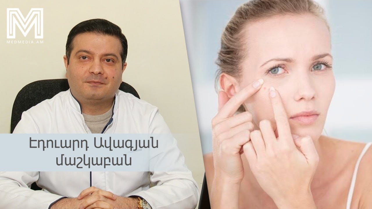 Երեք խորհուրդ բժշկից. ակնե #medmedia