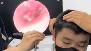 The satisfying earwax removal on TikTok 