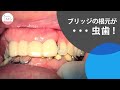 ブリッジの根元が虫歯で折れた!?ブリッジを一新して元どおりに Dental Bridge Is Broken!? Restore Dental Bridge