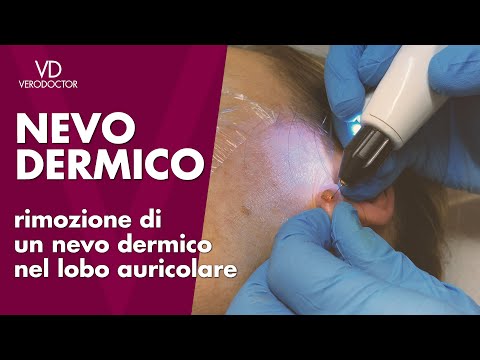 Rimozione di un nevo dermico nel lobo auricolare - piccolo problema estetico risolto VERODOCTOR