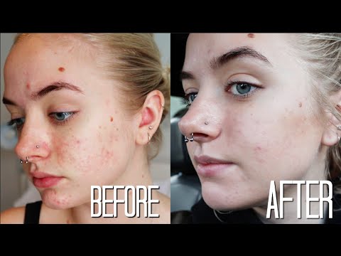 How to Get Rid of Acne Scars | My Herbal Face Peel Experience | Maddi Bragg