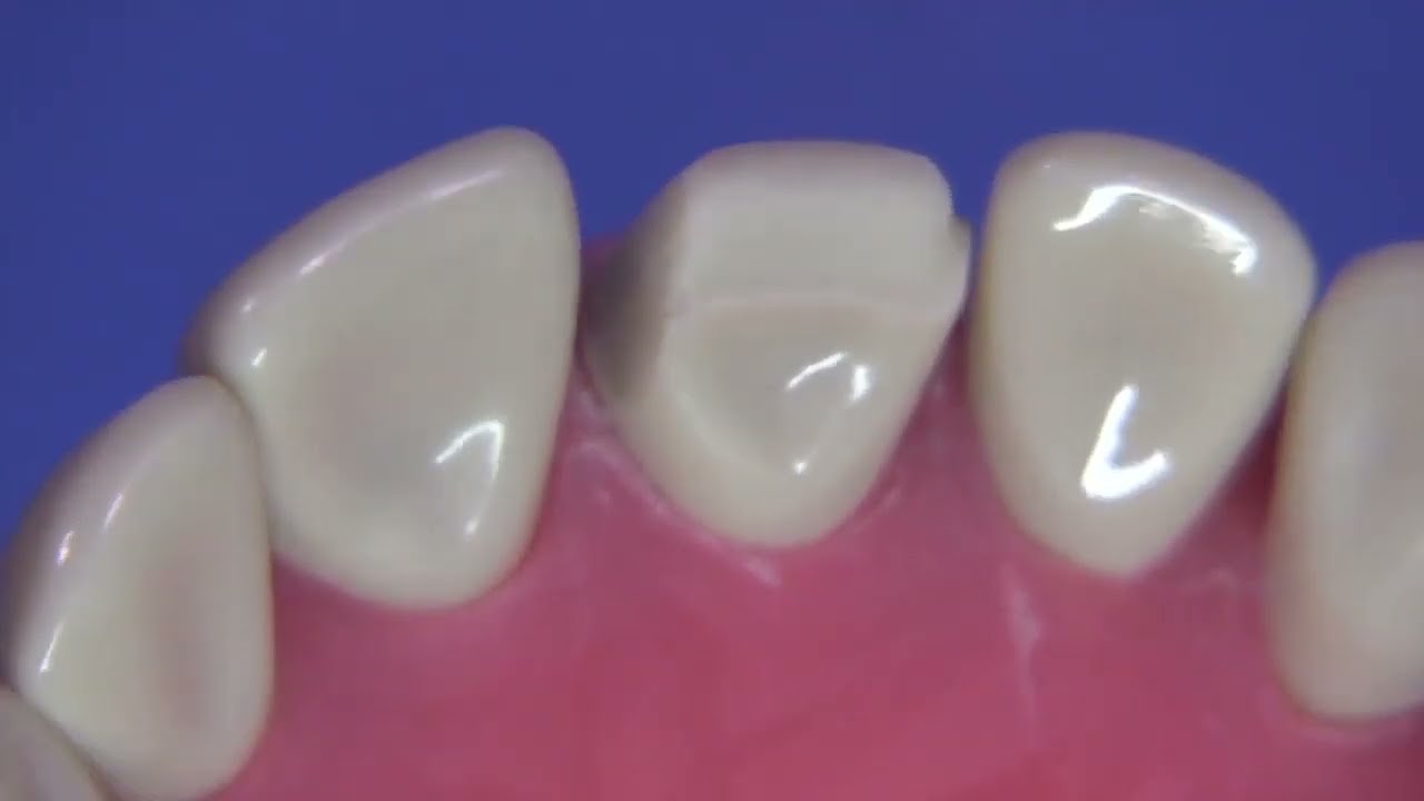 Porselen Lamina Veneer 4- Linguali Saran Veneer Kesimi