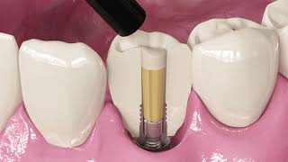 Silverplug- Anti-bacterial implant system sealer that fights peri-implantitis: Instructions for use