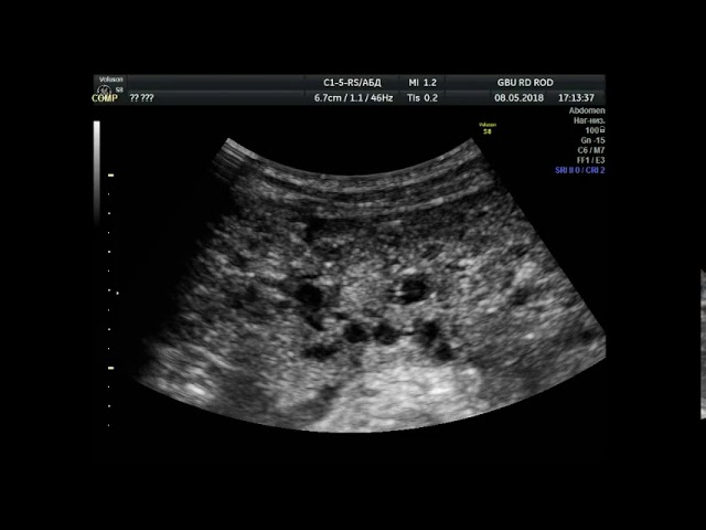 мезотелиома