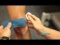 Taping - Patellofemoral Pain Syndrome