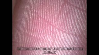 Minor Creasing In The Friction Ridge Skin