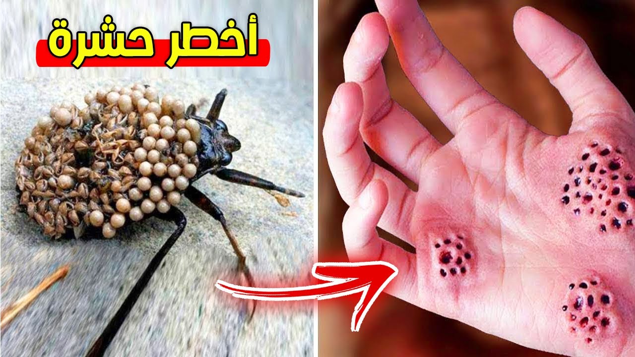 احترس منها.. أخطر 10 لدغات مؤلمة في عالم الحيوانات !!