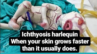 Harlequin-type ichthyosis\ when your skin grows at a faster rate than it usually does.