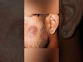 चेहरे का काला निशान और उपचार #pigmentation #hyperpigmentation #scars #shortsfeed #shorts #ytshorts