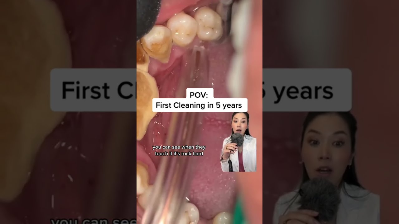 5 Years Of Plaque Build Up Get Your Cleanings Tartar Buildip Dentist Dentistry