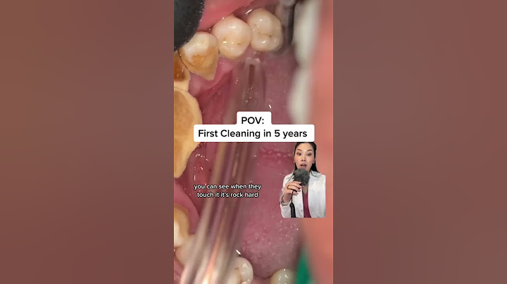 5 years of plaque build up. Get your cleanings! #plaque #tartar #buildip #dentist #dentistry