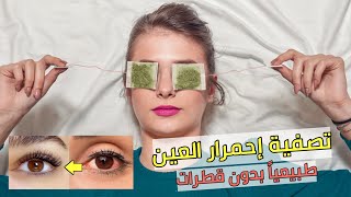 علاج احمرار العين من السهر والهاتف - 4 وصفات طبيعية مجربة تصفي العيون 100%