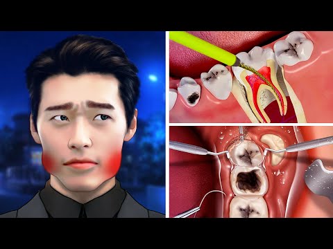 ASMR Dental Cleaning: Tooth Decay, Pulp Removal and Dental Implant Process