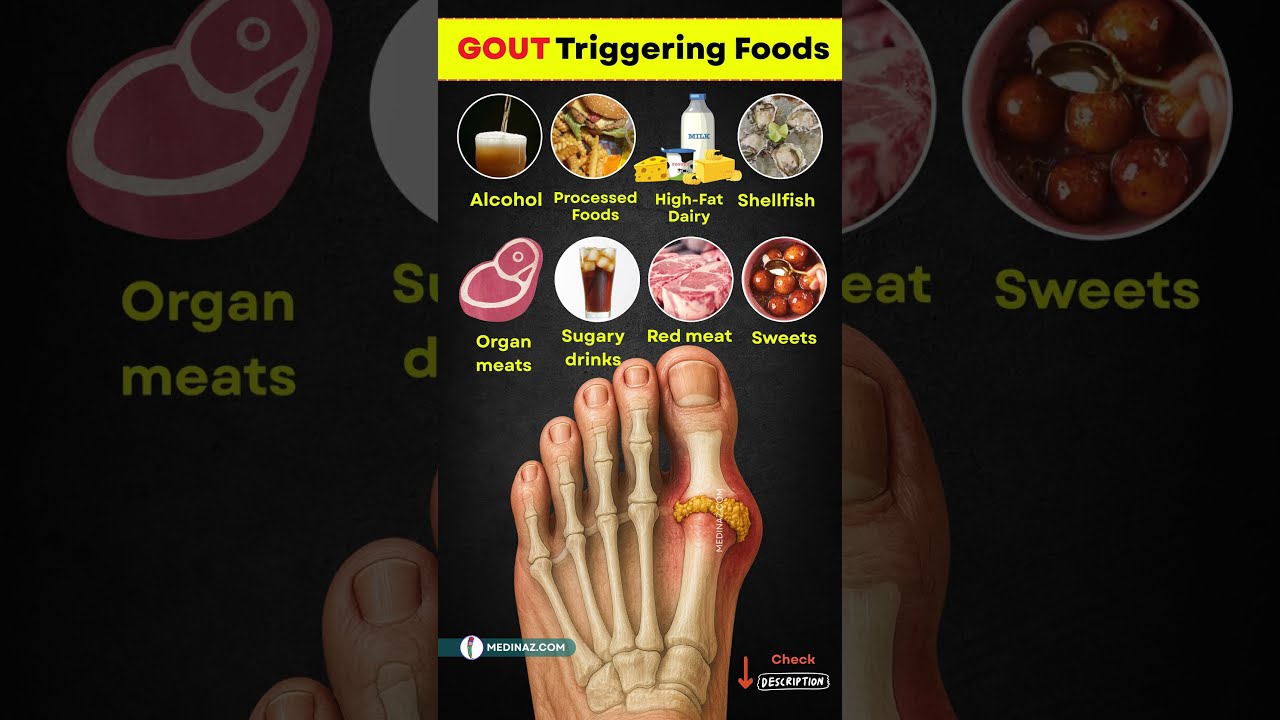  Avoid These 10 Foods To Prevent Gout Pain