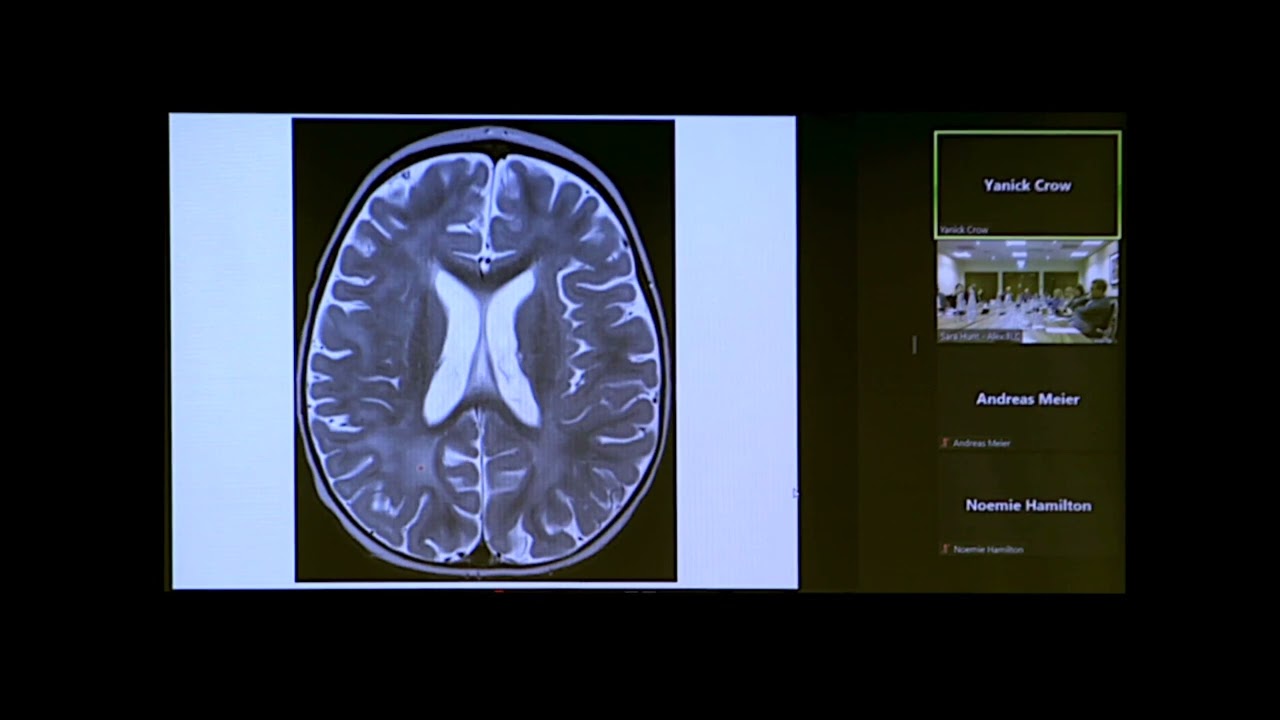 Aicardi Goutières Syndrome - Dr Yanick Crow, University of Edinburgh MRC Human Genetics Unit