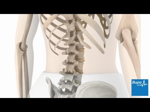 How idiopathic scoliosis occurs